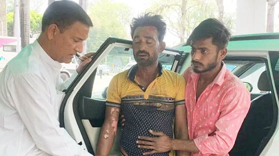 लापरवाही: बिजली के तारों की चपेट में आकर बुरी तरह झुलस गया लाइनमैन, अस्पताल में भर्ती