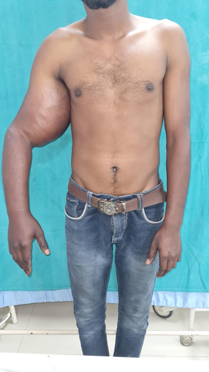 एम्स: फिर सामने आया चिकित्सकों का हुनर, सर्जरी से निकाली हाथ में बनी 5.6 किलो की गांठ