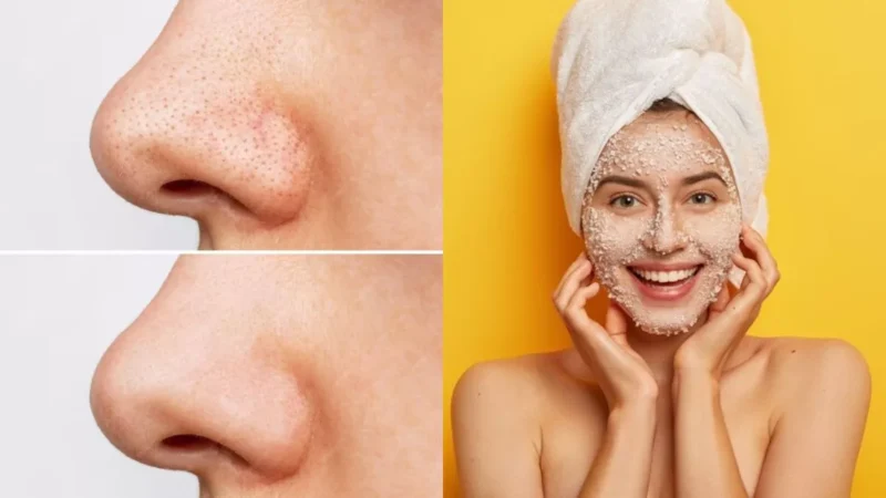 देखभाल: ब्लैकहेड्स से छुटकारा पाने के लिए आजमाएं ये प्रभावी घरेलू नुस्खे
