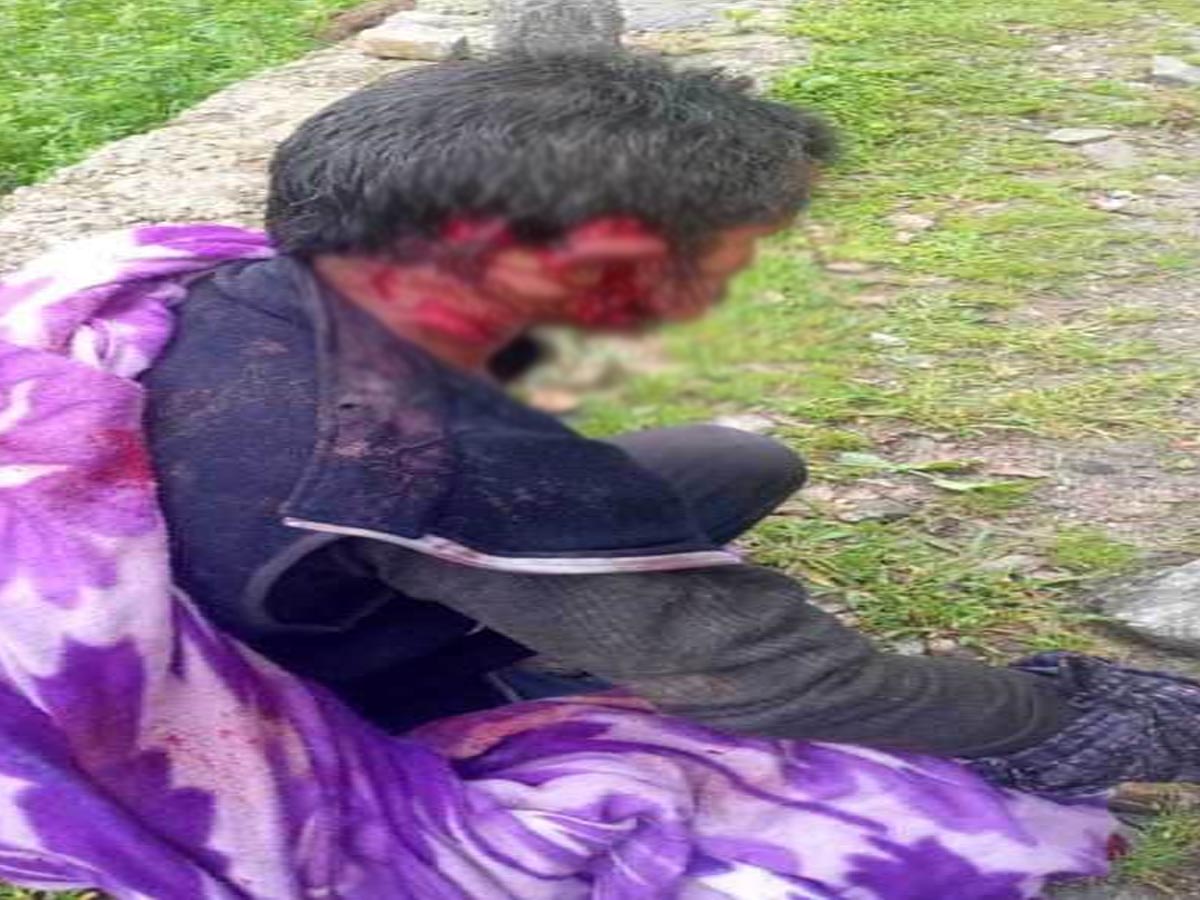 दहशत: सेब के बगीचे में काम कर रहे चौकीदार पर भालू ने किया हमला, घायल  हायर सेंटर रेफर