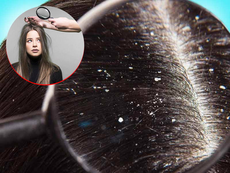 घरेलू नुस्खे: मानसून के दौरान रूसी से परेशान हैं? इन 5 घरेलू उपायों को अजमाएं