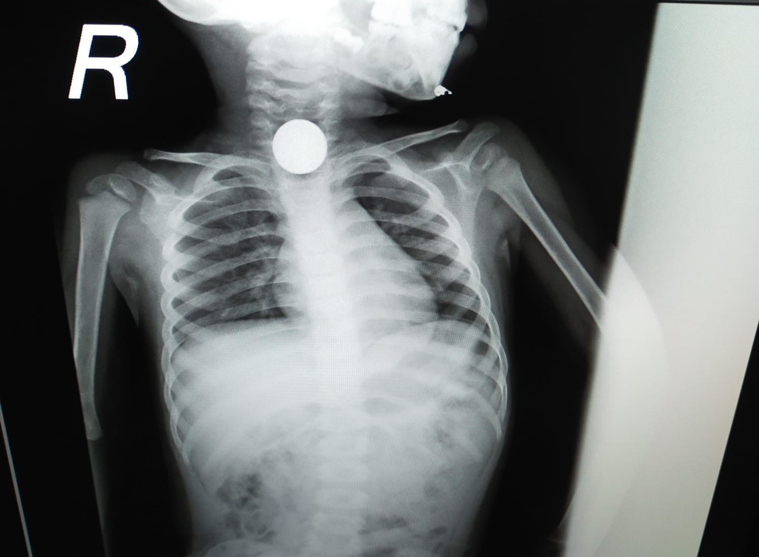 हुनर: बच्चे ने निगल लिया 20 रुपये का सिक्का, डॉक्टरों ने ऑपरेशन करके निकाला