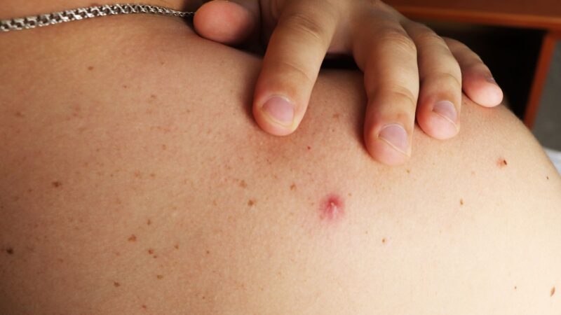 हैल्थ टिप्स: पीठ के मुंहासों की समस्या से हैं परेशान? जानिए इससे छुटकारा पाने के तरीके