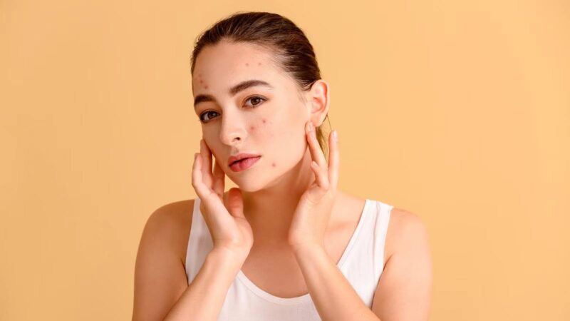 देखभाल: मुंहासें होने के पीछे हो सकते हैं ये कारण, न करें नजरअंदाज