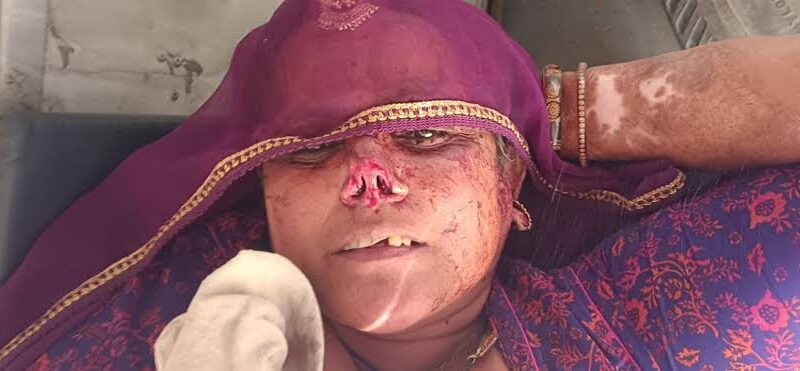 सनक: दामाद ने कैंची से काट दी सास की नाक, कटा हुआ हिस्सा लेकर हुआ फरार; इलाके में हडकंप